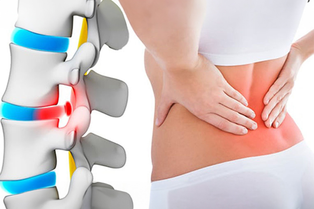 What is a herniated disc? Diagnosis and Treatment