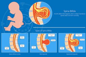 Konjenital Servikal Dermal Sinüs