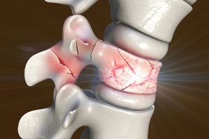 Omurga Çökme Kırığı Nedir