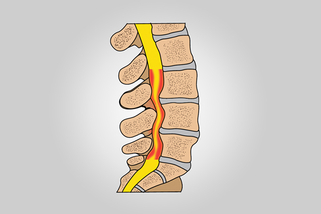 Omurga Kanal Daralması (Spinal Stenoz) ve Ameliyatları
