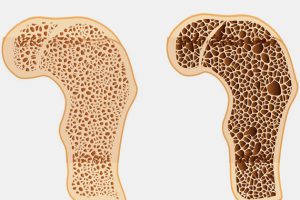 Osteoporoz