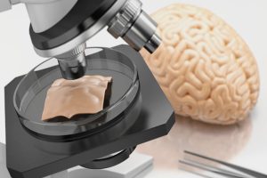 Stereotaktik Beyin Biyopsisi