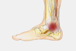 Tarsal Tünel Sendromu