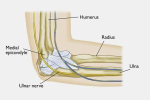 Ulnar Sinir Tuzak Nöropatisi