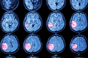 Beyin Tümörü Ameliyat Yöntemleri