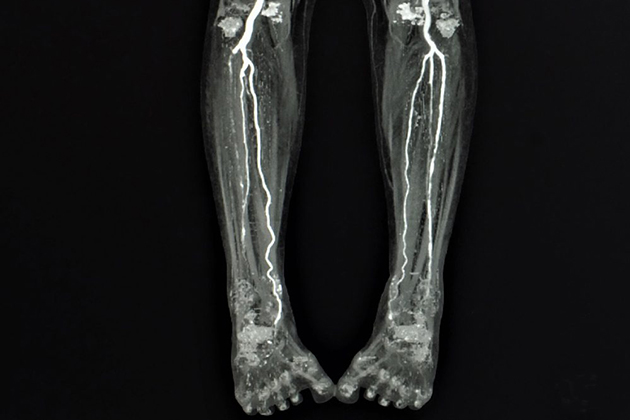 Peroneal Sinir Tuzaklanması