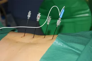 Radyofrekans Termokoagülasyon